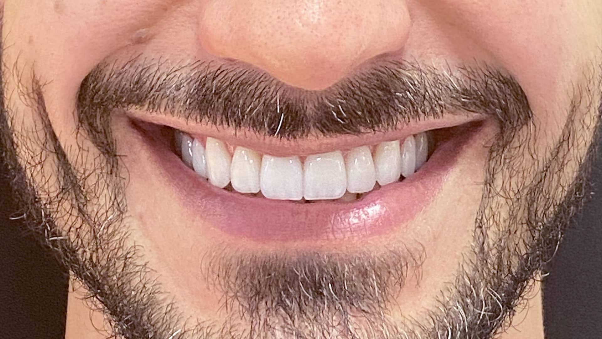 Facetas de porcelana resultado 1 — clínica odontológica em Cuiabá