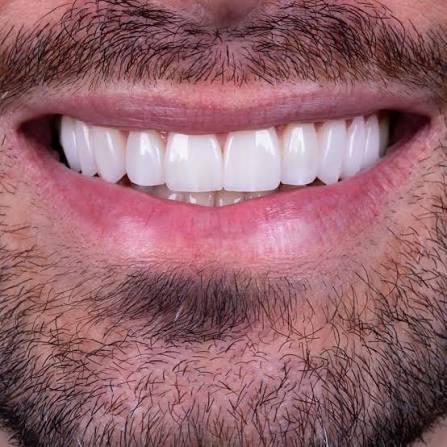 Facetas de porcelana resultado 4 — clínica odontológica em Cuiabá