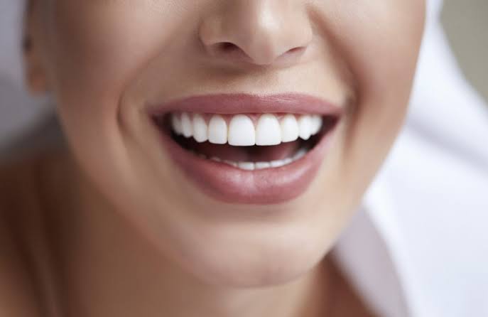 Facetas de porcelana resultado 5 — clínica odontológica em Cuiabá