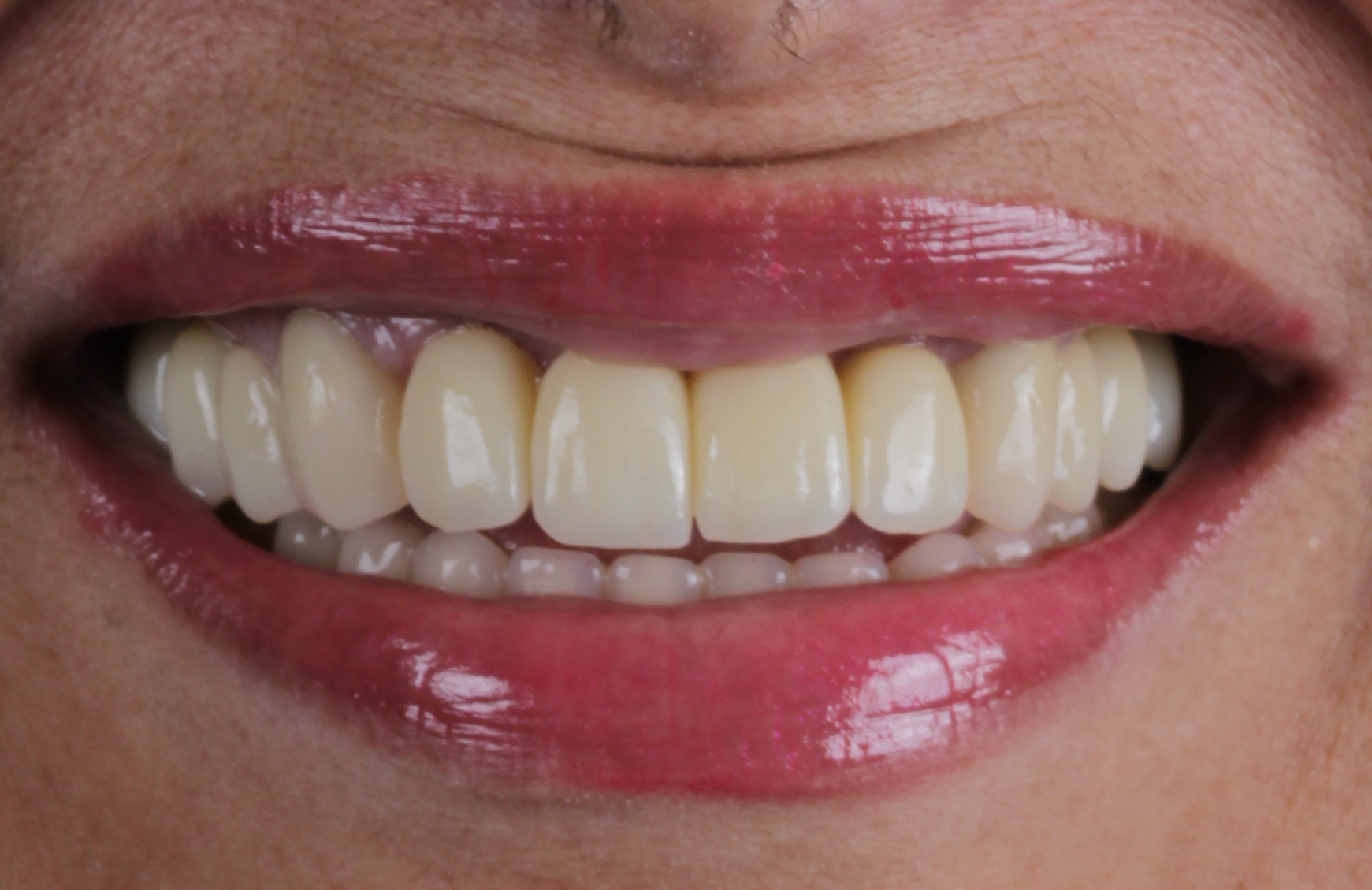 Implante dentario resultado 4 — clínica odontológica em Cuiabá