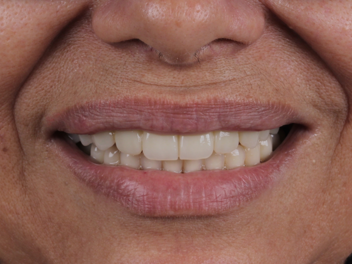 Implante dentario resultado 5 — clínica odontológica em Cuiabá