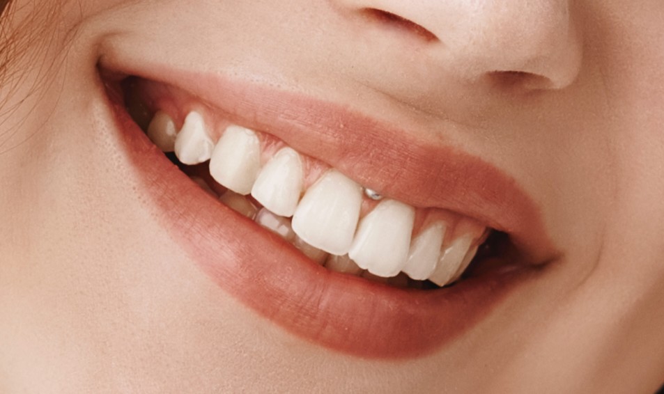 Invisalign resultado 1 — clínica odontológica em Cuiabá