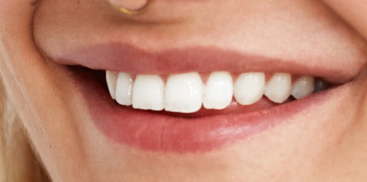 Invisalign resultado 2 — clínica odontológica em Cuiabá