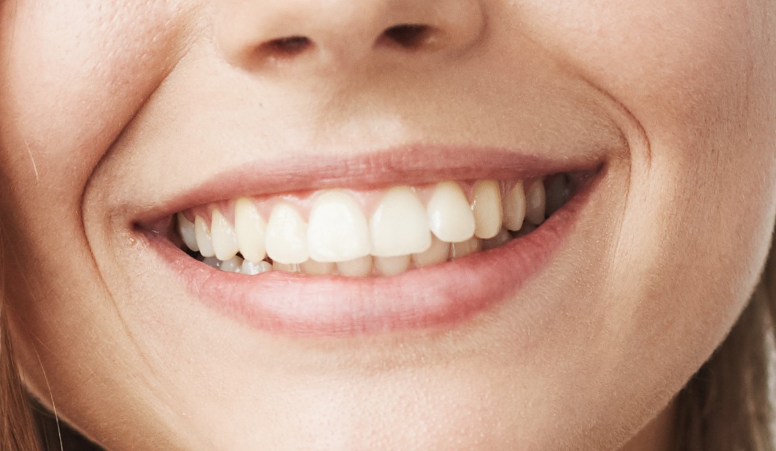 Invisalign resultado 3 — clínica odontológica em Cuiabá