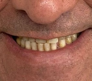 Coroa superiores antes — clínica odontológica em Cuiabá