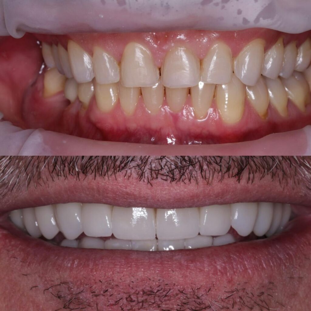 Facetas de Porcelana em Cuiabá