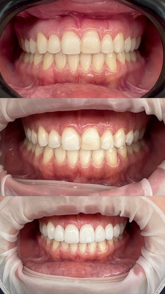 Facetas de Porcelana em Cuiabá